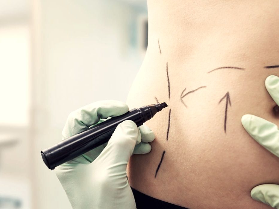 Marcação pré-operatória de cirurgia plástica